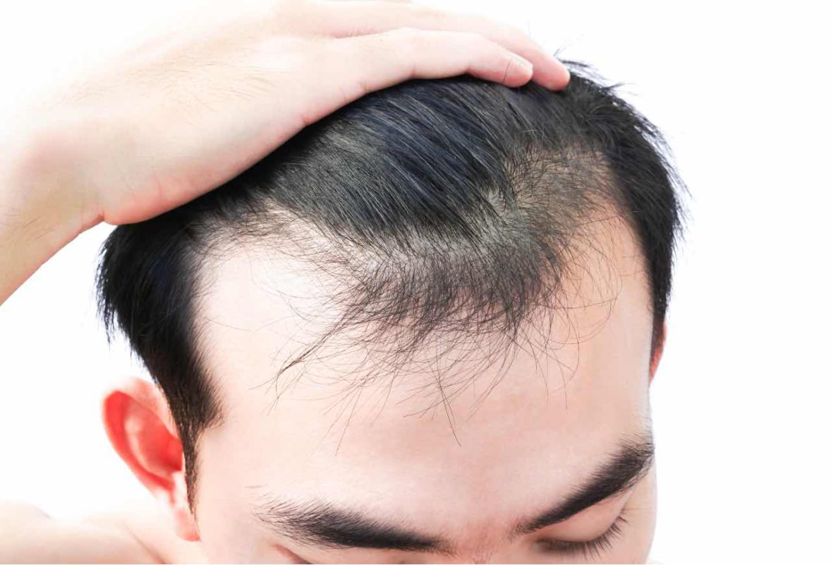 male pattern baldness treatment